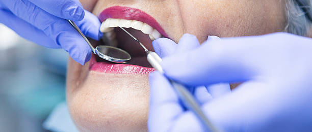 Best Emergency Wisdom Teeth Removal in Davidson, NC